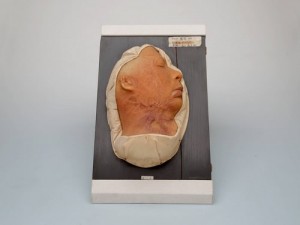 Model of Keloid